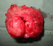 sex after removal of prostate gland sex after removal of prostate gland
